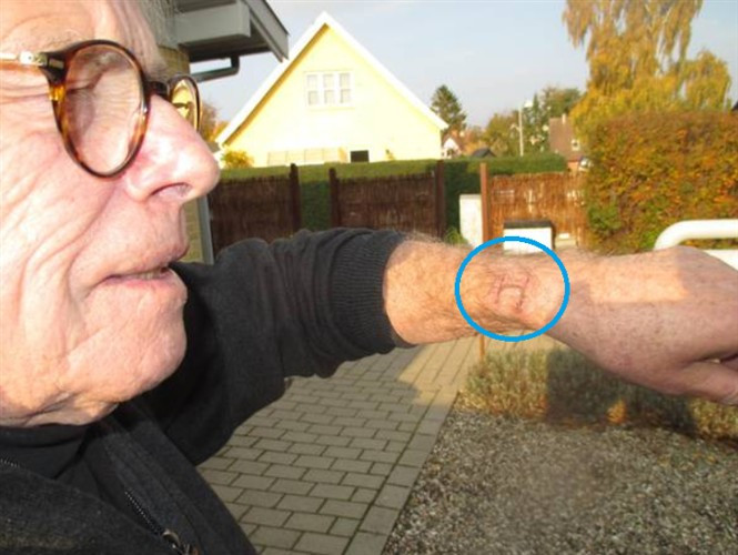 1448433970_man-claims-to-have-been-severely-burned-by-his-apple-watch.jpg